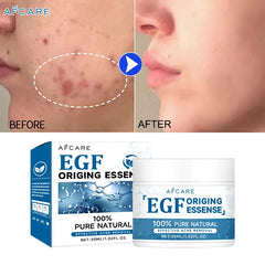 Afcare EGF Face Acne Treatment Cream Lightening Acne Remover Pimple Repair Skin Whitening Moisturizing Beauty Health Skincare