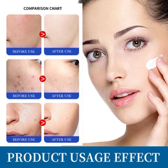 Afcare EGF Face Acne Treatment Cream Lightening Acne Remover Pimple Repair Skin Whitening Moisturizing Beauty Health Skincare