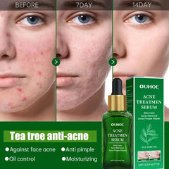 Acne Treatment Facial Serum Pore Shrinking Skin Care against Face Acne Pimple Spots Remover Cleaning Shrink Pores Tea Tree Serum